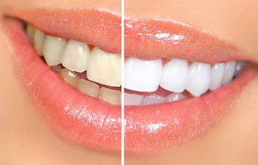 Teeth Whitening