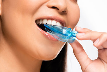 Custom Mouthguards