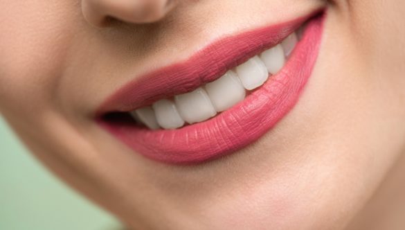 Are Porcelain Veneers Better than Dental Bonding?