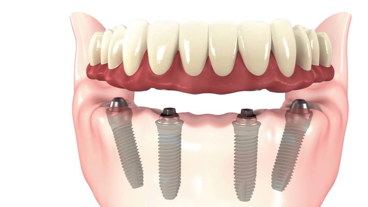 Dental Implants in Canton