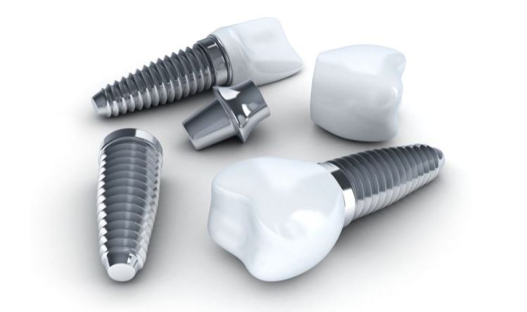Dental Implants and Missing Teeth