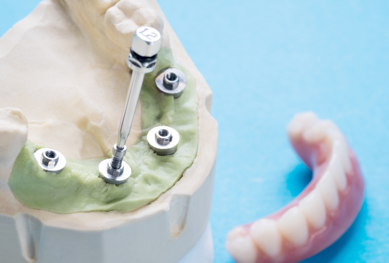 You Can with All on 4s in Canton GA BridgeMill Dentistry