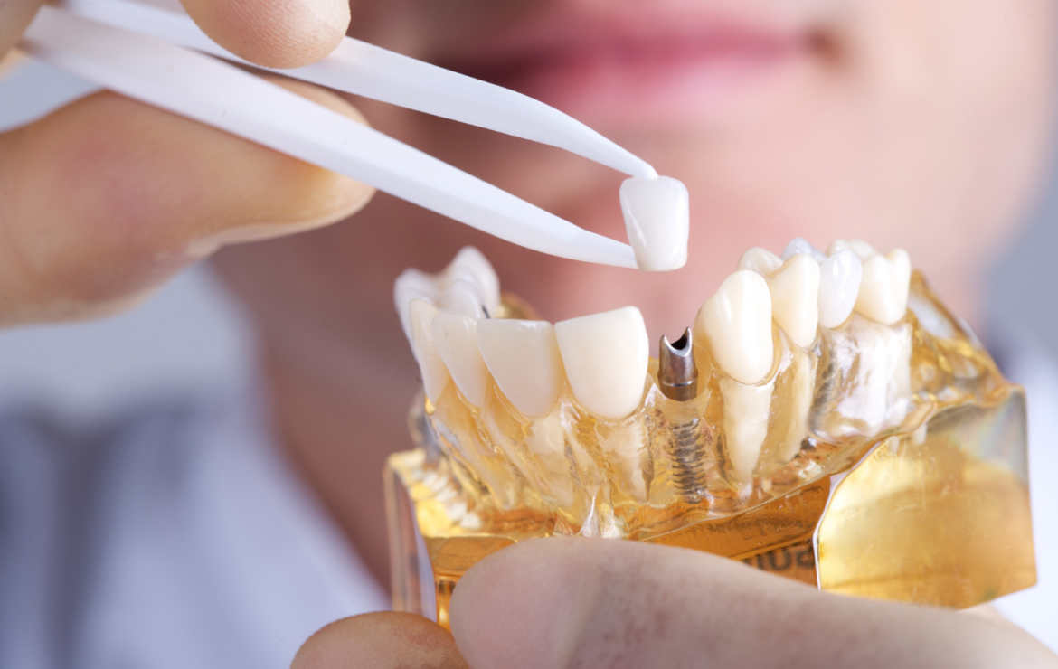 Revitalize Your Smile with Dental Implant Restorations and Repairs