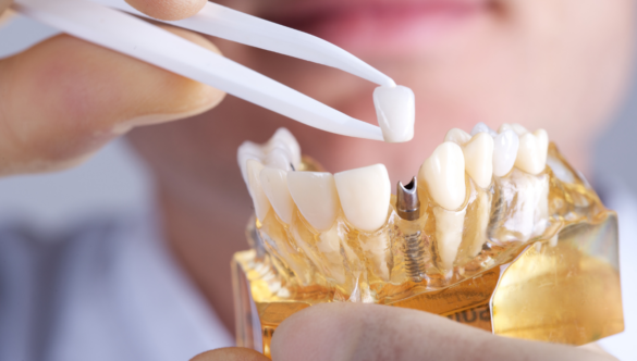 Revitalize Your Smile with Dental Implant Restorations and Repairs