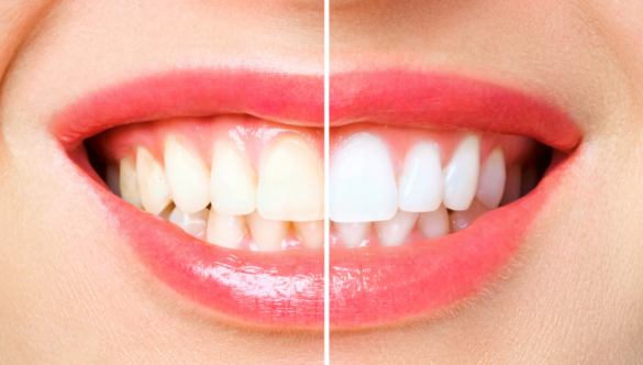 Why Professional Teeth Whitening is Better